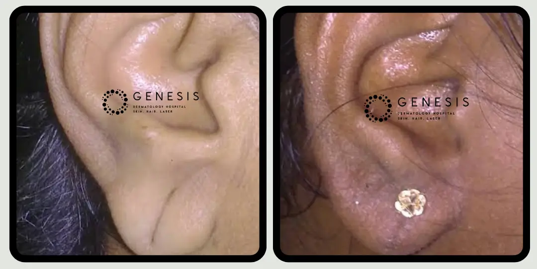 Ear lobe repair
