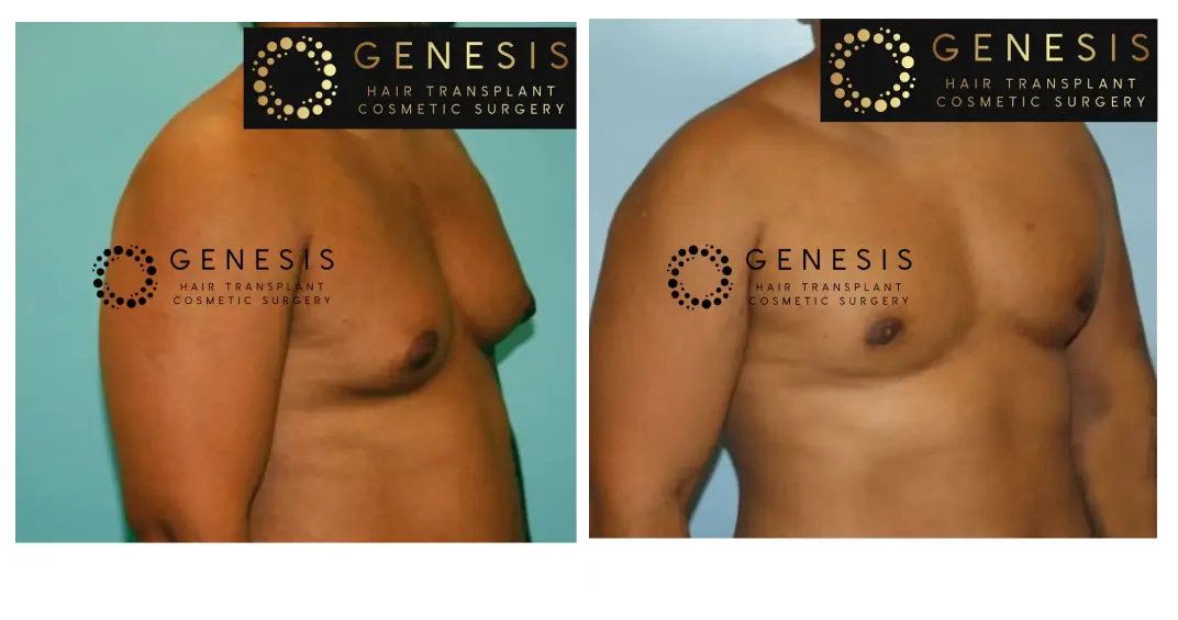 Gynecomastia