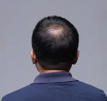 Hair Loss in Men