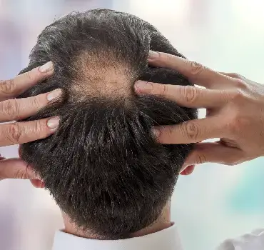Male Pattern Baldness